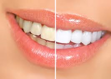 Load image into Gallery viewer, MIAMI teeth whitening
